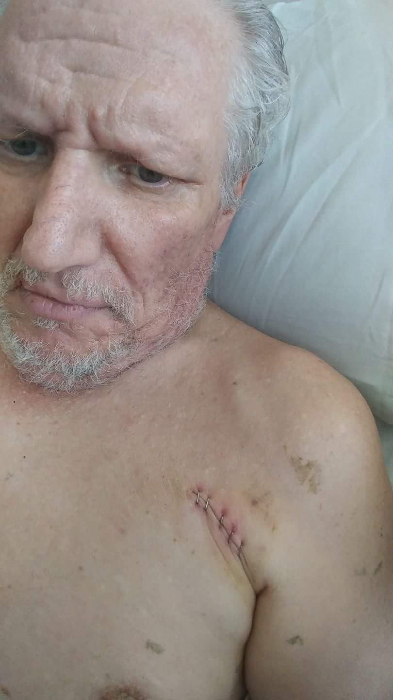 Picture of my atrial fibrillation scar