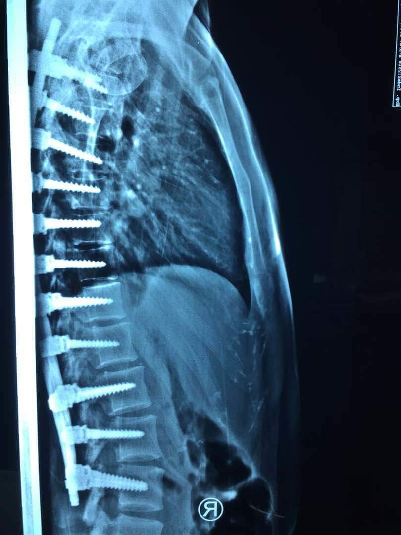 Side View of her back after surgery