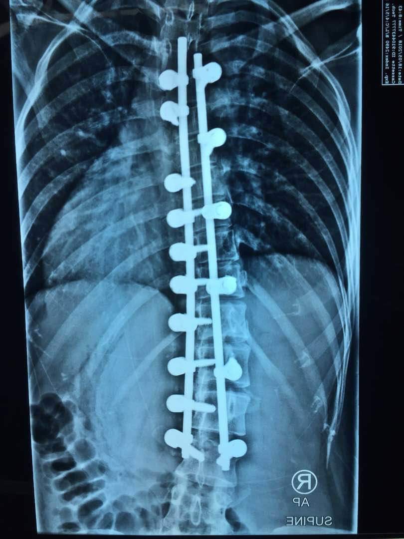 Front view of her back after surgery