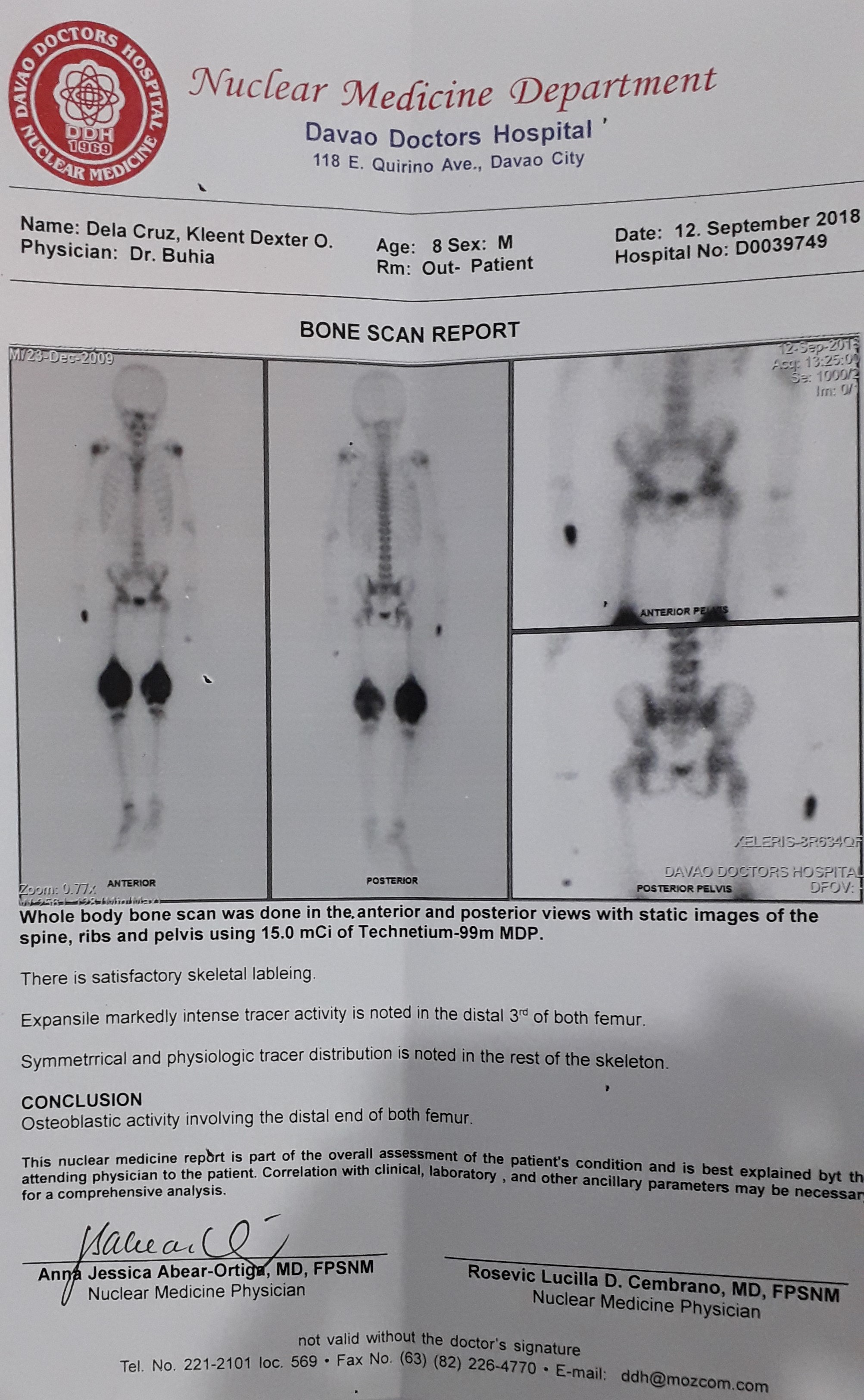 Bone scan results - osteoblastic activity in BOTH FEMURS