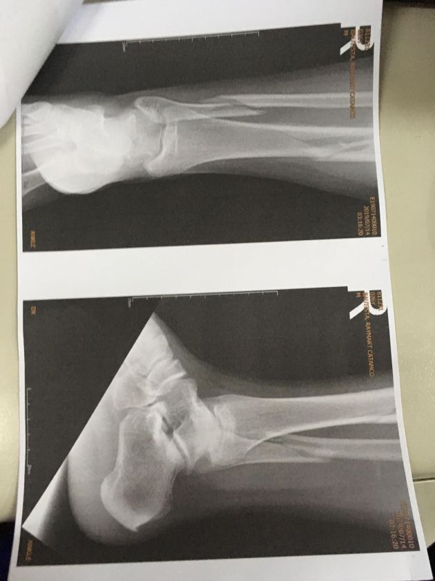 (X-ray images of his right leg done at Amang Rodriguez Memorial Medical Center)