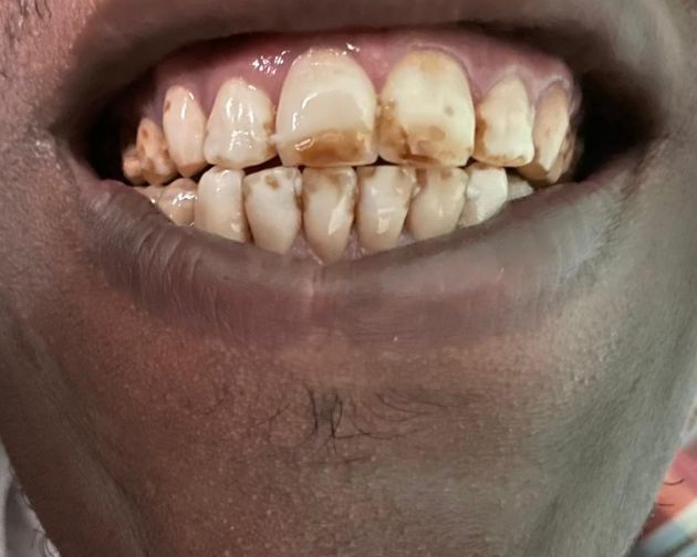Clinical Example of Arusha Teeth
